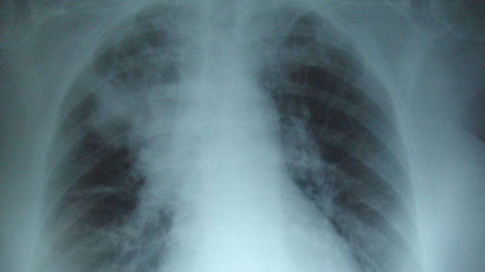 Przewlekłe zapalenie płuc ze zniszczeniem miąższu płucnego u osoby z mukowiscydozą/fot. Wikipedia