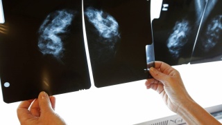 Raka piersi diagnozuje się zbyt późno. W pierwszej fazie jeszcze można go zniszczyć