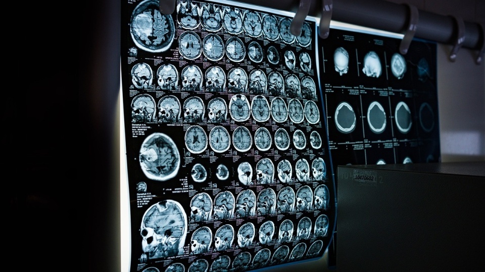 Specjaliści z Bydgoszczy opracowali nową metodę bardziej precyzyjnego diagnozowania glejaka, pozwalającą skuteczniej operować ten wyjątkowo groźny nowotwór mózgu. Zdjęcie ilustracyjne/fot. Pixabay