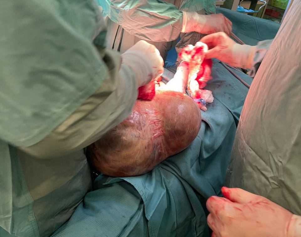 Lekarze kaliskiego szpitala usunęli 42-letniej kobiecie olbrzymi guz jajnika/fot. Szpital Kalisz/Facebook