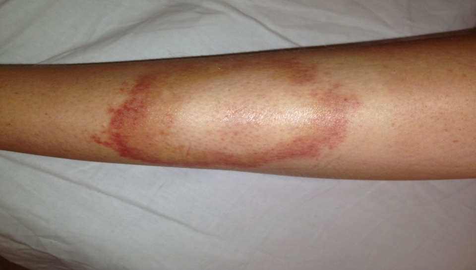 W pierwszym okresie u większości zakażonych boreliozą pojawia się niebolesny rumień, w którego środku widać przejaśnienie/fot. dr Paweł Rajewski