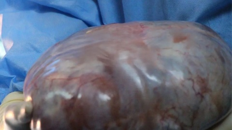 Specjaliści z Oddziału Klinicznego Ginekologii Onkologicznej Centrum Onkologii w Bydgoszczy usunęli ogromnego guza jajnika/Fot. Centrum Onkologii w Bydgoszczy